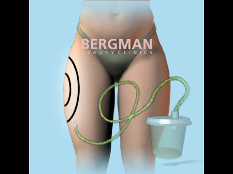 Animatie van een Liposuctie