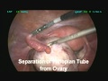 Ovarian Endometrioma - Laparoscopic Management Ovarian Endometrioma - Laparoscopic Management