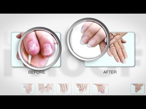 how to treat onychorrhexis