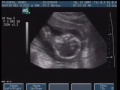 Ultrasound 19-JUL-2007