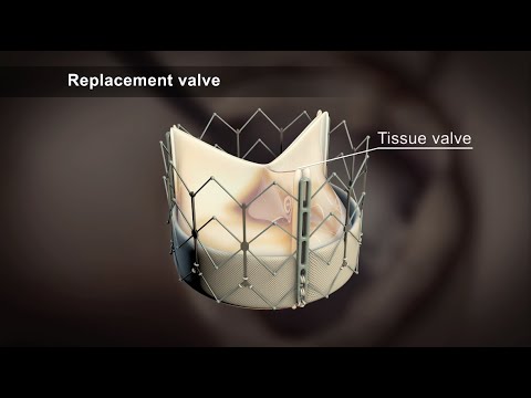 how to repair pyloric valve