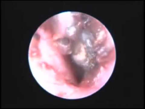 how to dissolve ear wax plug