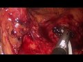 Pancreatic Insulinoma Laparoscopic Resection 