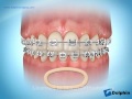 Correcting Midline Discrepencies Using Rubber Bands