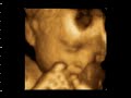 3d-4d-ultrasonografia-crianca-bebe-terceiro-trimestre