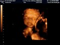 Twins at 28 weeks, 3D ultrasound in color, part 2