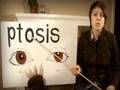 Ptosis by Dr. Tegan Quin