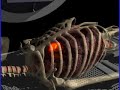 Respiratory Gating System Radiotherapy - Trilogy Radiotherapy