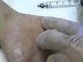 Botox Procedure for Palmar Hyperhidrosis Botox Procedure for Palmar Hyperhidrosis