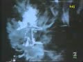 Alucine tve2