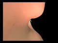 Birth Control Pills Cause Embryonic Abortions Pro-Life Video