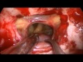 ENDOSCOPIC RESECTION OF CRANIOPHARYNGIOMA
