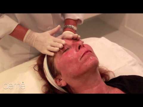 how to treat rosacea