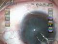 Cataract Surgery