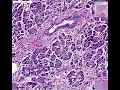 Histopathology Pancreas - - Adenocarcinoma