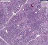 Histopathology Pancreas - - Adenocarcinoma