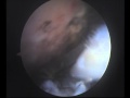 Arthroscopic Assessment Of Reverse L-Shaped Tear Of Rotator Cuff Arthroscopic Assessment Of Reverse L-Shaped Tear Of Rotator Cuff