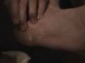 My 2 plantar warts Part III