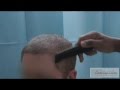 Hair Transplant Revolution using BHT & FUE - Dr. Sanusi Umar