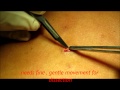 sebaceous cyst back getting removed