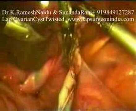 Laparoscopy Twisted Ovarian Cyst ...