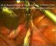 Laparoscopy Twisted Ovarian Cyst Video (Lap Ovary Cyst)