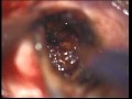 Cavernous Brain Malformation - Resection Cavernous Brain Malformation - Resection