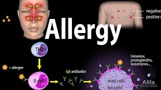 Allergy - Mechanism Symptoms Risk factors Diagnosi