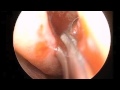 Endoscopic Ethmoidectomy with Implantation Endoscopic Ethmoidectomy with Implantation