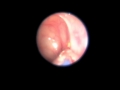 Balloon Dilation of Ostium for Chronic Sinuitis under Local Anesthesia Balloon Dilation of Ostium for Chronic Sinuitis under Local Anesthesia