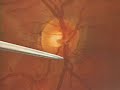Lymphoma of the Brain - Part 2