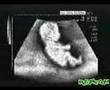 Scan Bayi Yang Asyik Menendang Didalam Kandungan