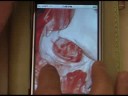 HiDef Medical 3D on iPhone HiDef Medical 3D on iPhone