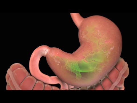how to take care of ulcers in the stomach