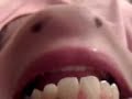 Chin monster