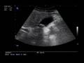 RUQ_Acute cholecystitis classic eg