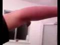 Metal in my freinds arm