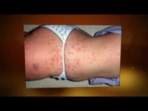 how to treat folliculitis