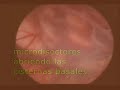 QUISTE ARACNOIDEO  TEMPORAL  TRATAMIENTO NEUROENDOSCOPICO
