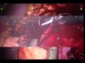 Robotic Partial Nephrectomy