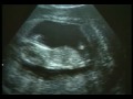 mocni w duchu  matko życia  aborcja