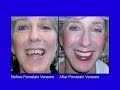 Correcting Peg Lateral - A Common Dental Condition