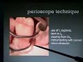 Perioscopy Technique