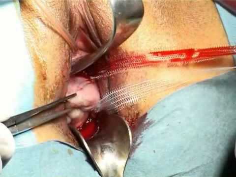 how to perform cervical cerclage