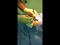 Cyst removal