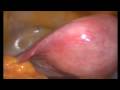video laparoscopia