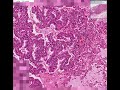 Histopathology Lung--Bronchiolo-alveolar carcinoma Histopathology Lung--Bronchiolo-alveolar carcinoma