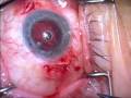 IOL Exchange, PPV and scleral sutured PCIOL by Steven G. Safran MD