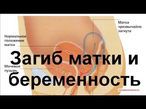 Видео: Наилучшие позы для зачатия при загибе матки