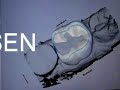 cerec crown